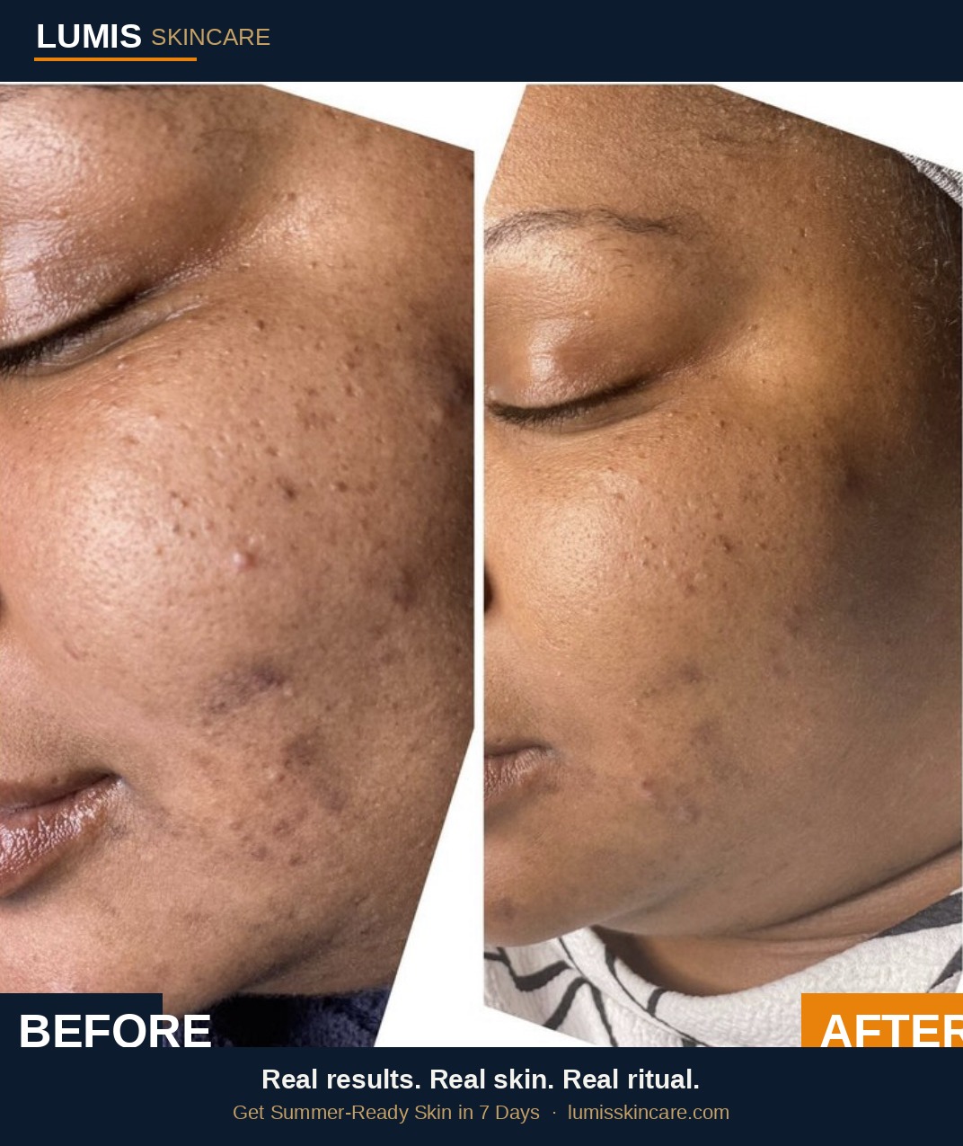 Real client results — before and after using Lumis Skincare brightening products